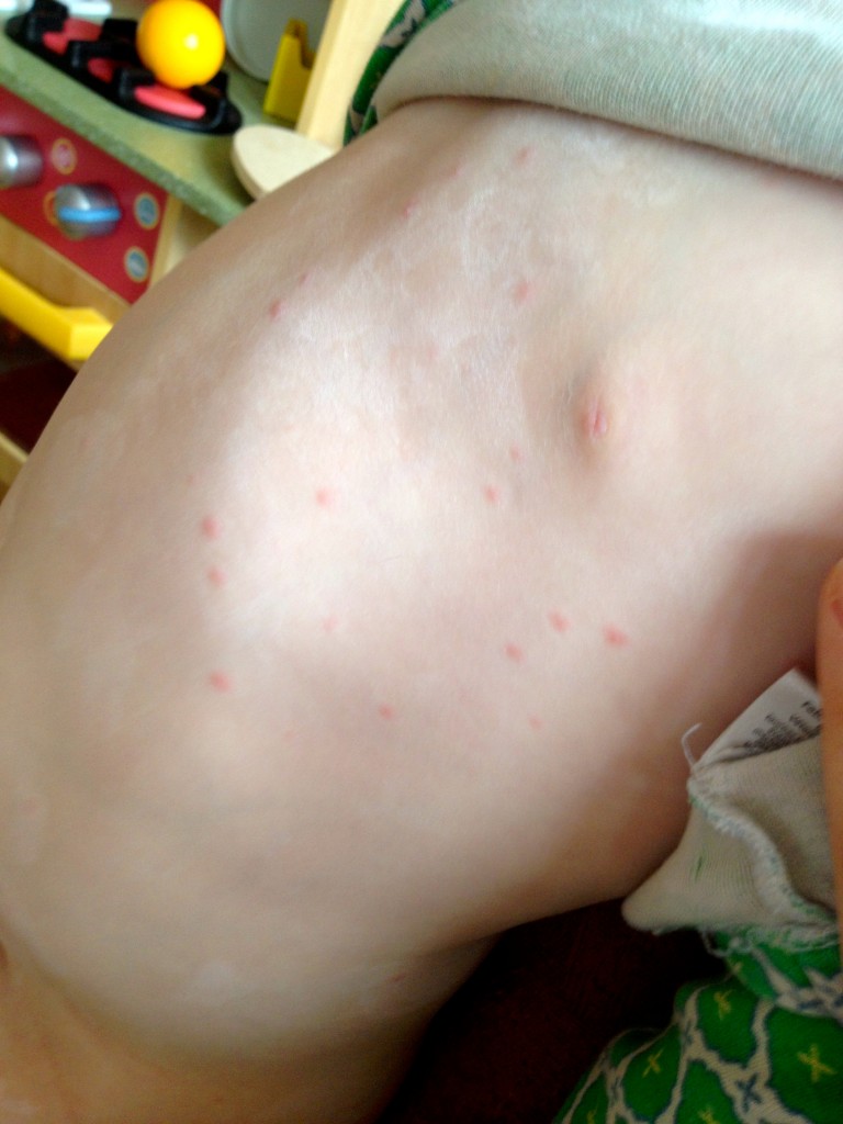 Tips for coping with chicken pox - Toby and Roo